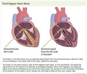 HeartBlock