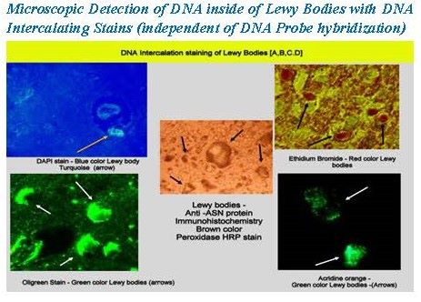 microbial-dna-globular-liquid-crystal-like-deposits-inside-lewy-bodies-in-four-lewy-dementia-patients_Page_4