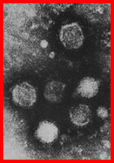 Microscopic image of persistent Powassan Disease