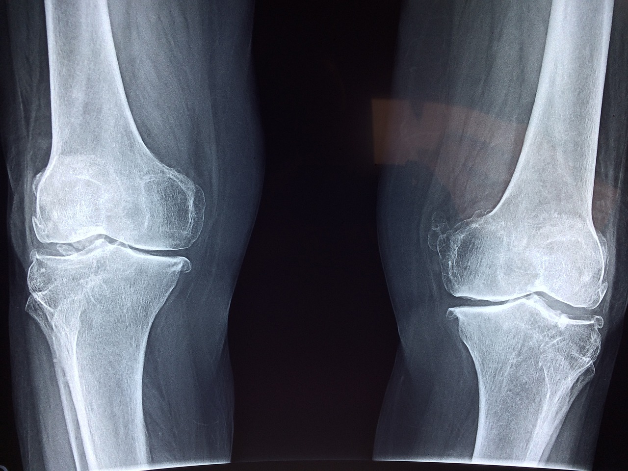 photo of x-ray-knees